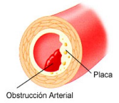 Aterosclerosis
